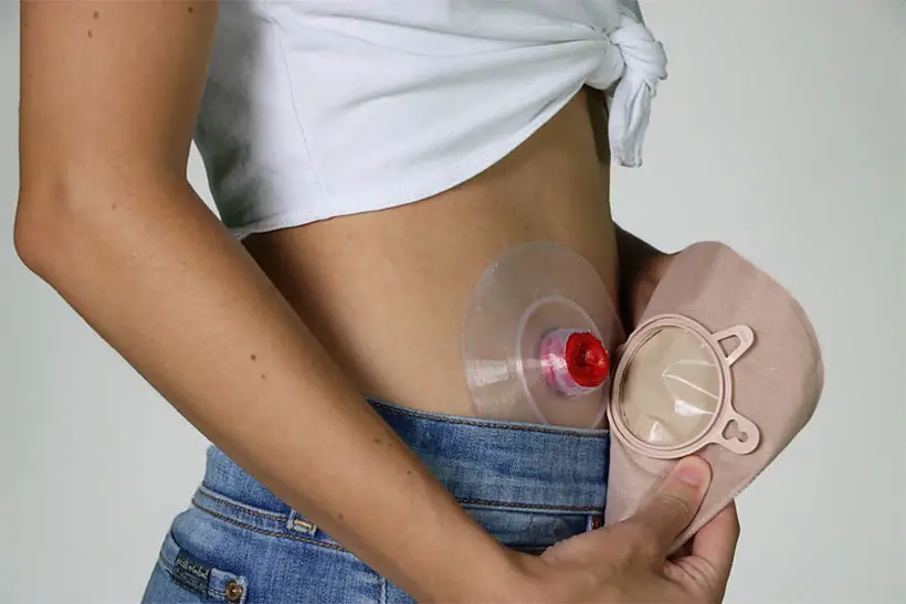 Odapt Silicone Wafer for Ostomy Bag by Jessica Nissen, Ivana Llobet, and Patricia López
