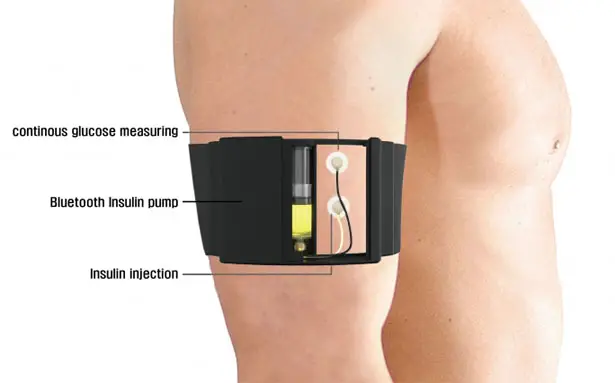 ARMC - Wearable Artificial Pancreas for Diabetics Patient by JEON Kiseop and Juhyeong LEE