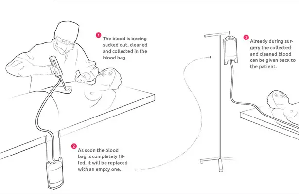 Bloop Medical Device to Recycle Your Own Blood During Surgery