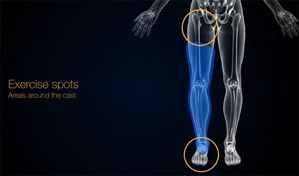 Bones Orthopedic Cast with Sensors by Pedro Nakazato Andrade