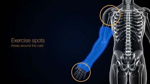 Bones Orthopedic Cast with Sensors by Pedro Nakazato Andrade