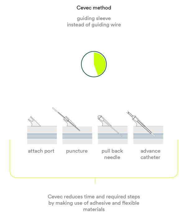 Cevec: Central Venous Catheter for Emergencies by Gabriel Mueller