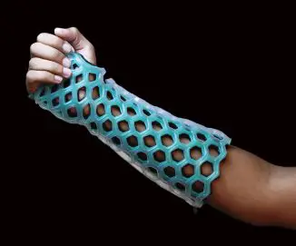 FlexiOH – Next Generation of Flexible Orthopedic Cast with Good Skin Ventilation