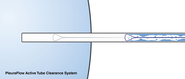 PleuraFlow Medical Device by Carbon Design